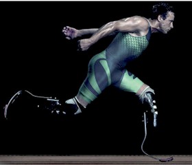 Amputáció után Amputáció után