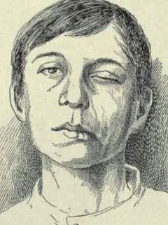 Perifériás bénulás Perifériás bénulás