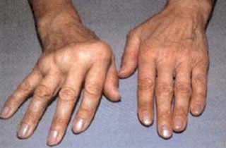 pcp-s kéz pcp-s kéz