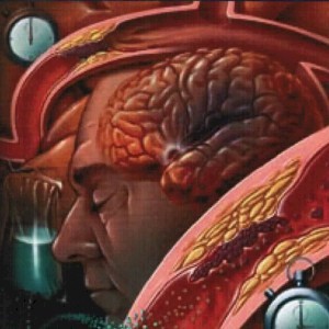 Agyvérzés - stroke Agyvérzés - stroke